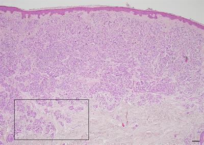 High charge of cerebroid nests in nodular melanomas predicts tumor aggressiveness and high mutational tumoral burden: a pilot study